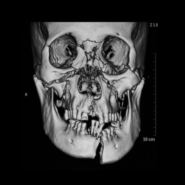 Cirugía Maxilofacial(